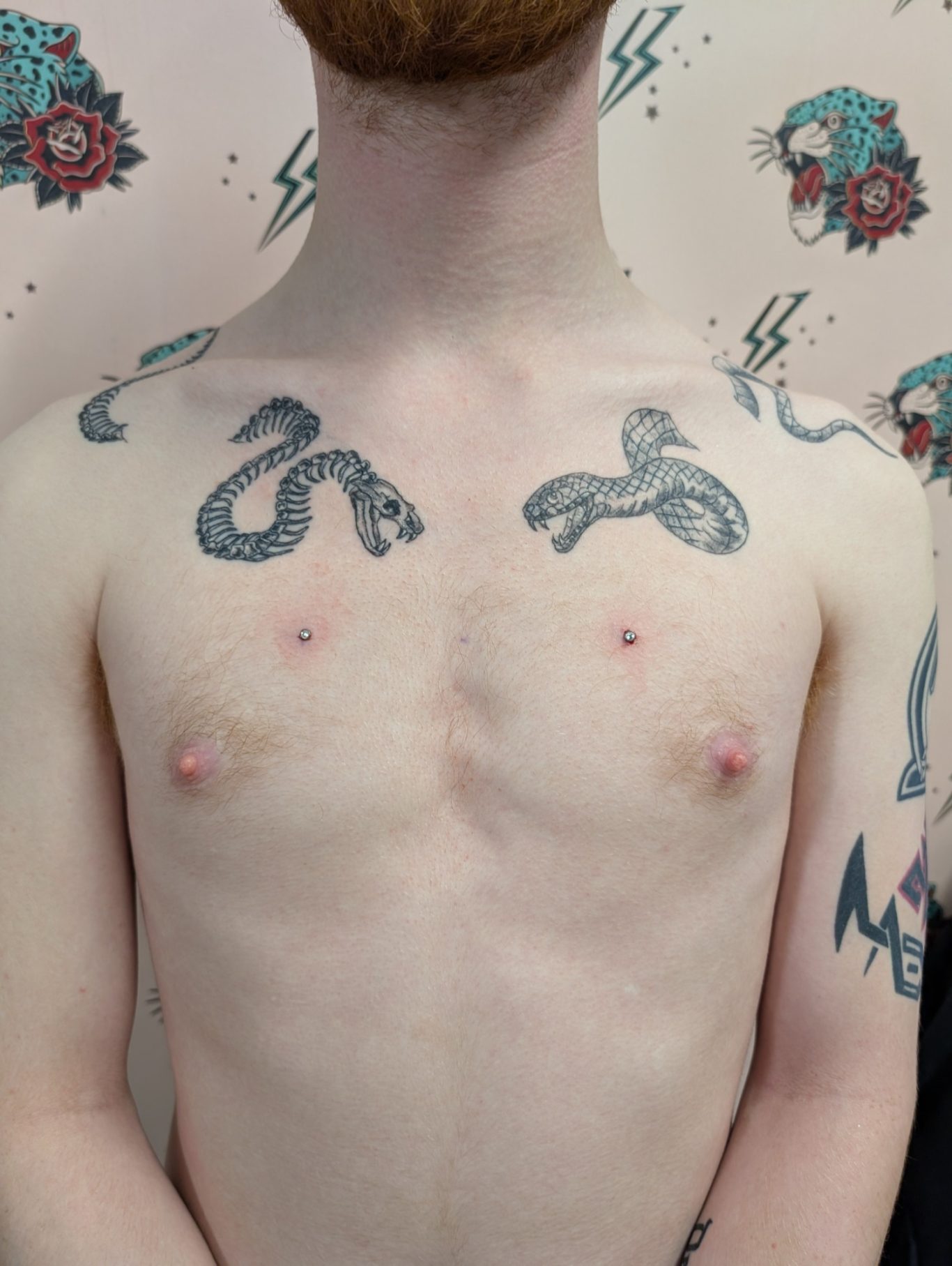 Chest Microdermal Implants
