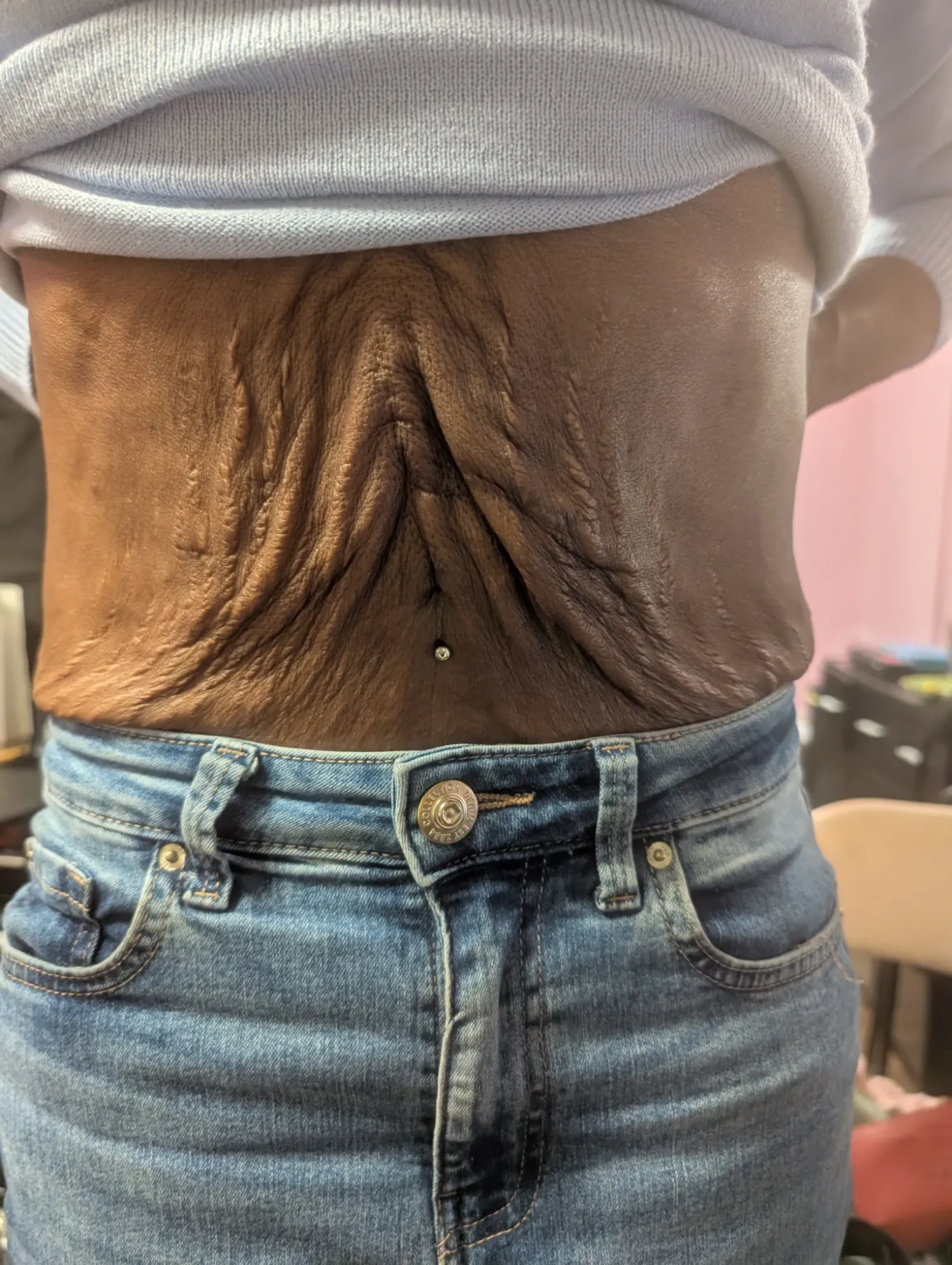 Abdominal Dermal Implant