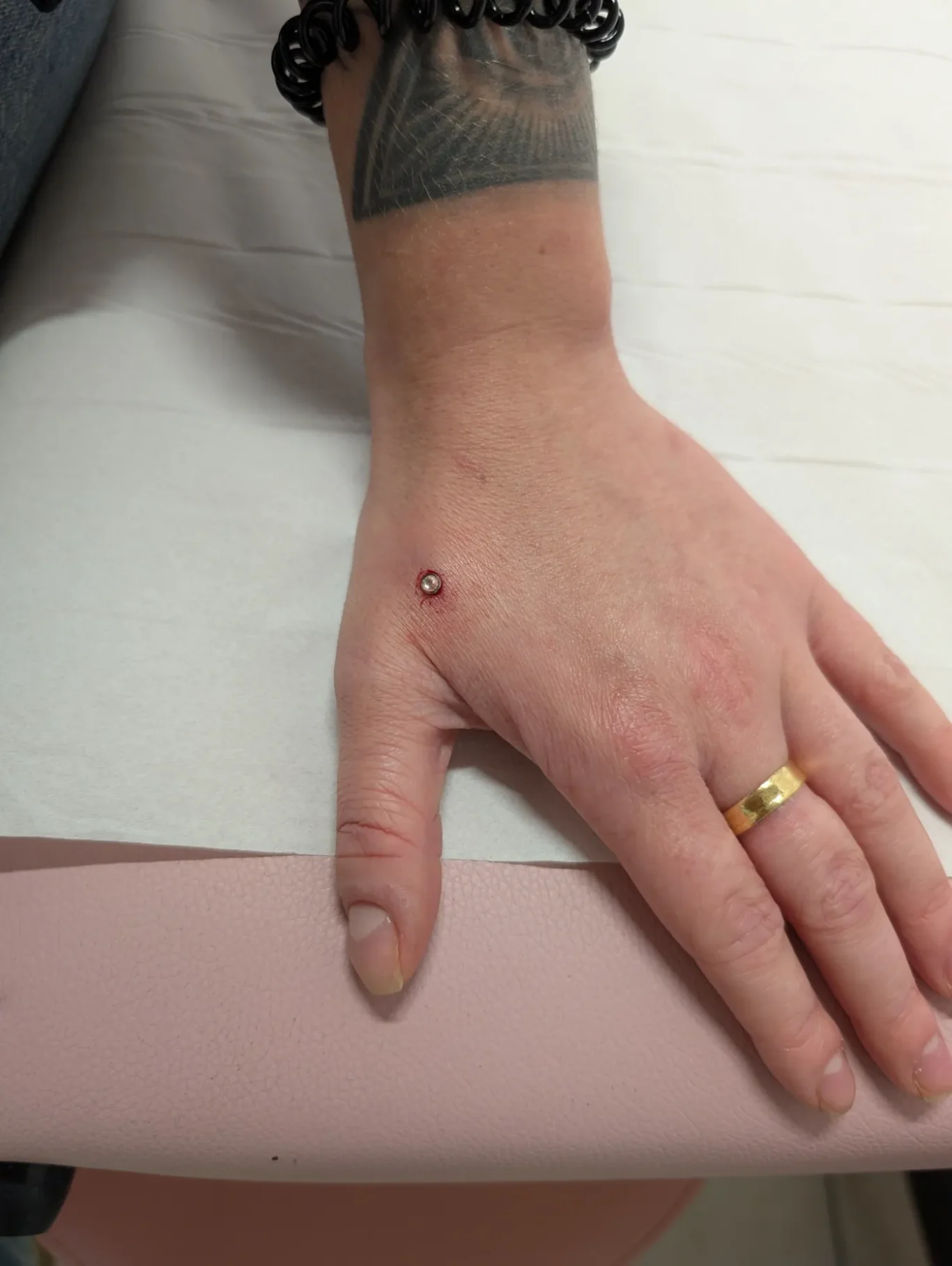 Hand Microdermal Implants