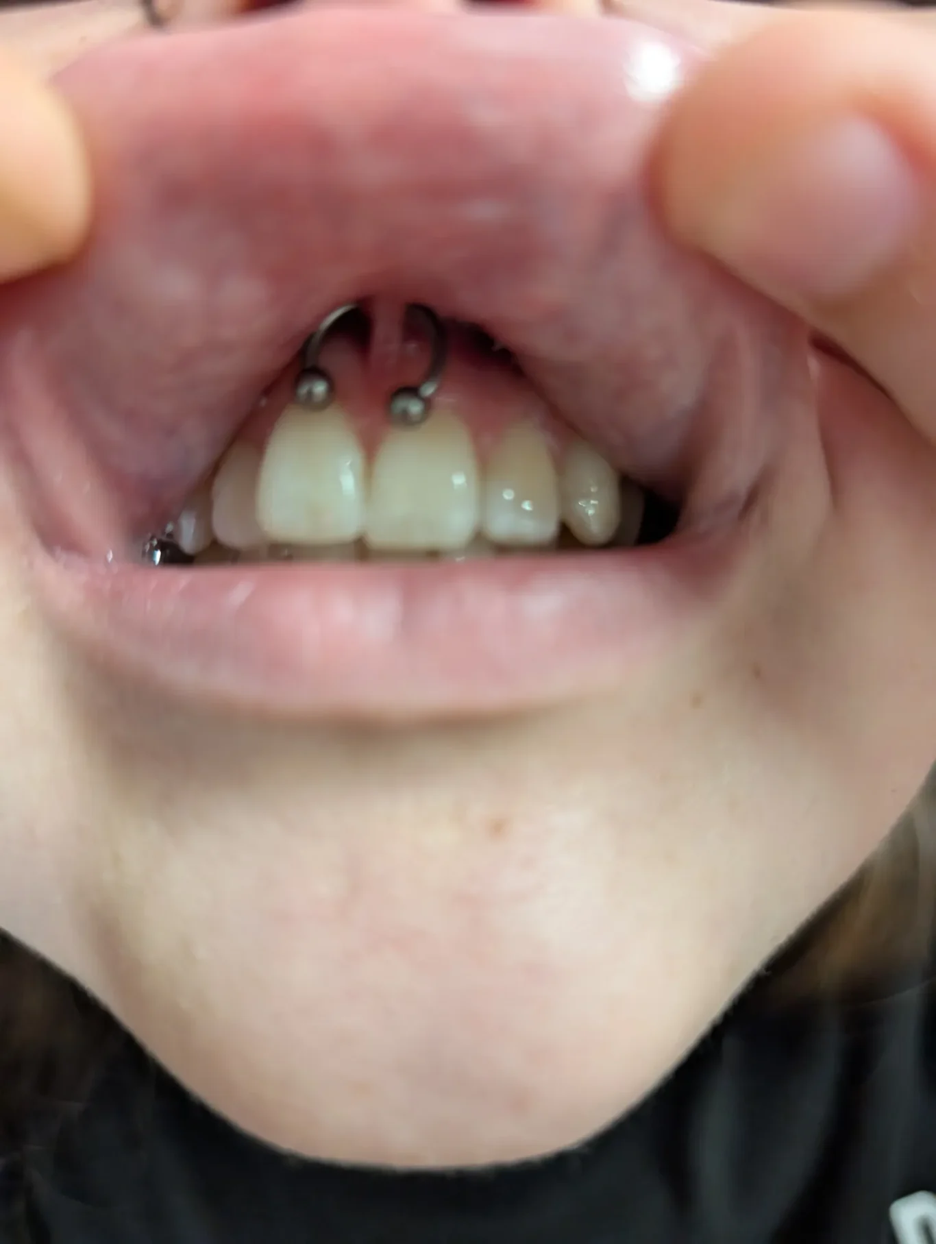 Smiley Piercing