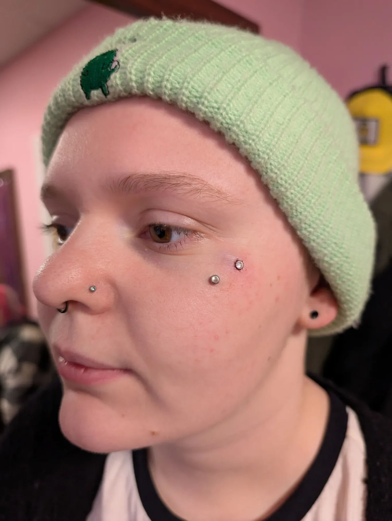 Facial Dermals
