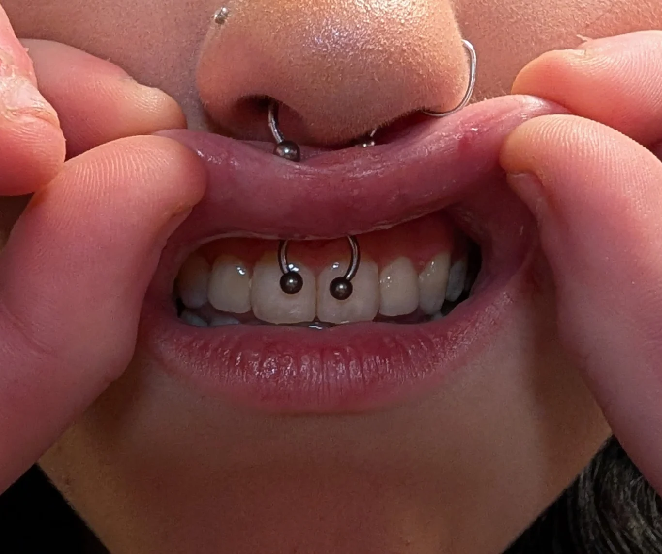 Smiley Piercing